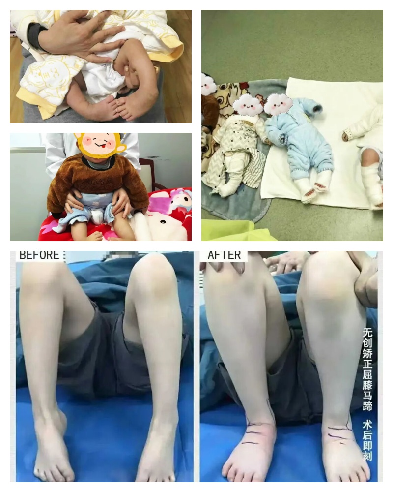 【足畸形患者的康复之光】跨越海峡的廖氏正骨疗法落地北京长城中医医院